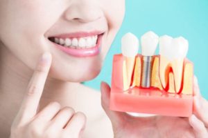 Implantes Dentales