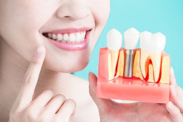 Lee más sobre el artículo Los implantes dentales de carga inmediata, una técnica rápida y cómoda