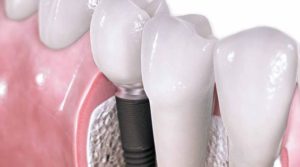 Extracción de piezas dentales durante la ortodoncia