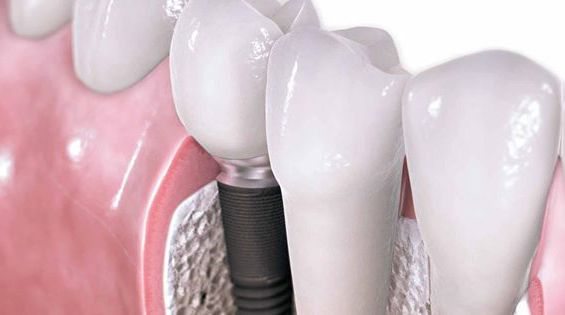 En este momento estás viendo Extracción de piezas dentales durante la ortodoncia