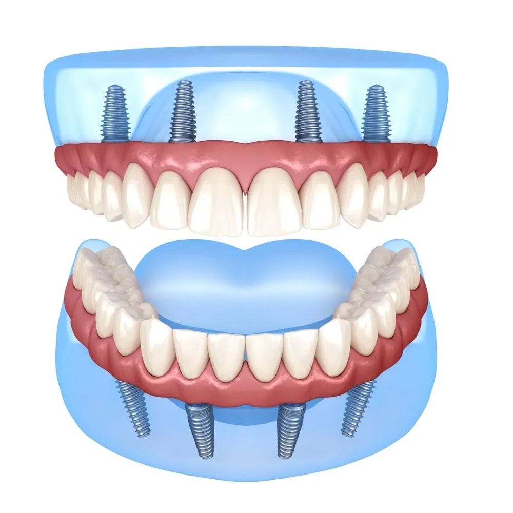 Prótesis Dental Carga Inmediata