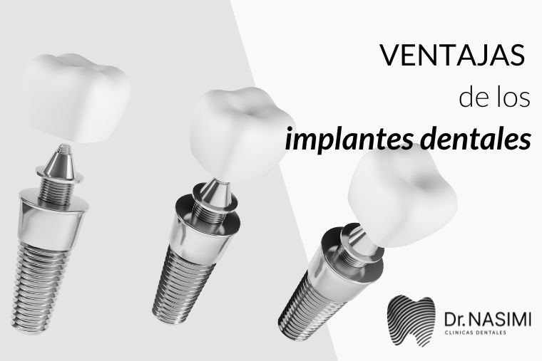 Lee más sobre el artículo Ventajas de los implantes dentales