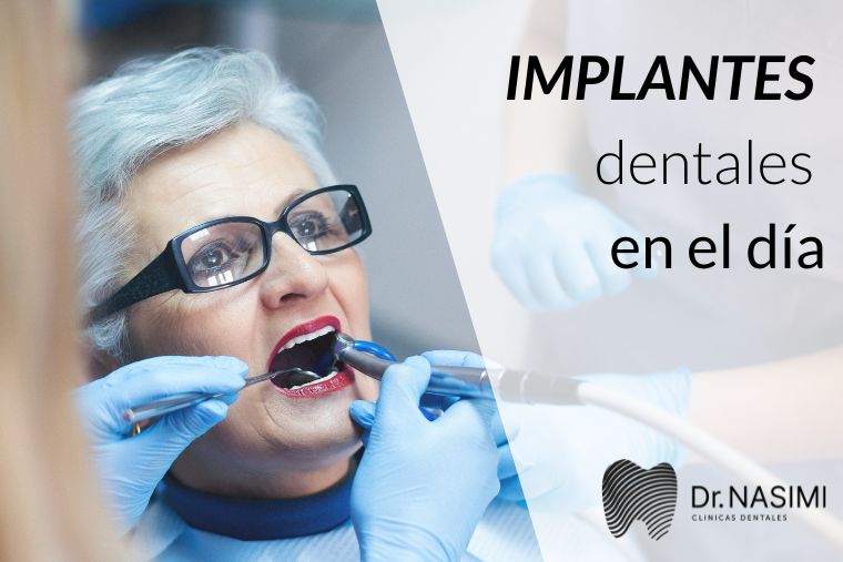 Lee más sobre el artículo Implantes dentales en el día
