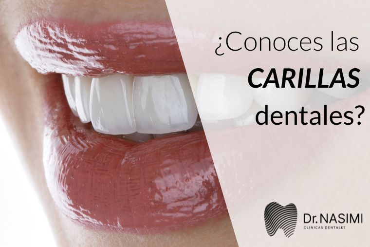 Lee más sobre el artículo ¿Conoces las carillas dentales?
