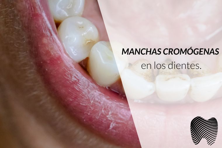 Lee más sobre el artículo Manchas cromógenas en los dientes