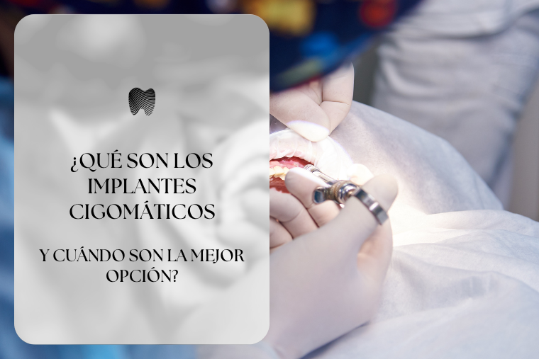 En este momento estás viendo ¿Qué son los implantes cigomáticos y cuándo son la mejor opción?