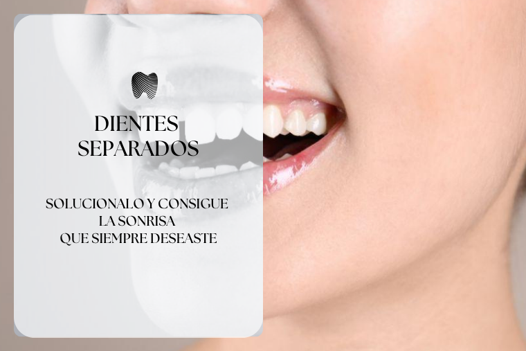 Lee más sobre el artículo ¿Dientes separados? descubre la forma de solucionarlo