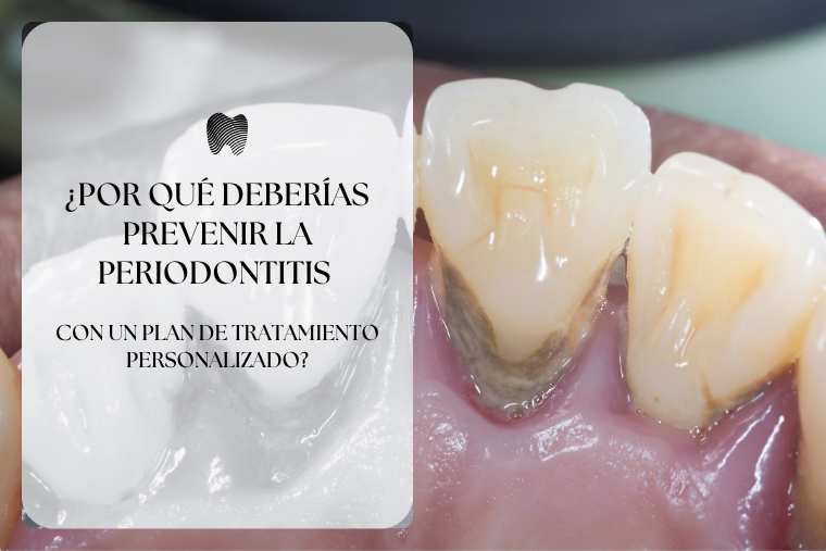 Lee más sobre el artículo ¿Por qué deberías prevenir la Periodontitis con un plan de tratamiento personalizado?