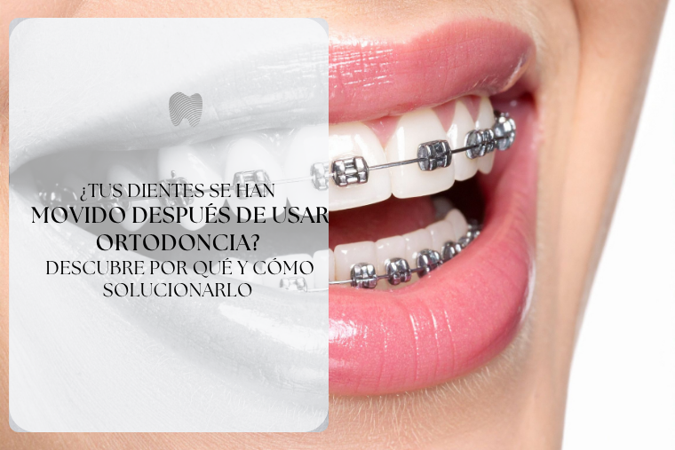 Lee más sobre el artículo ¿Tus dientes se han movido después de usar ortodoncia? Descubre por qué y cómo solucionarlo