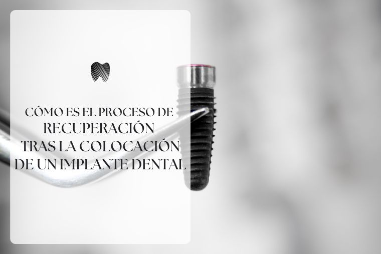 Lee más sobre el artículo Proceso de recuperación después de un implante dental
